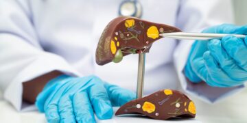 Fatty Liver Now Affects 1 in 3 Adults Without Warning Signs