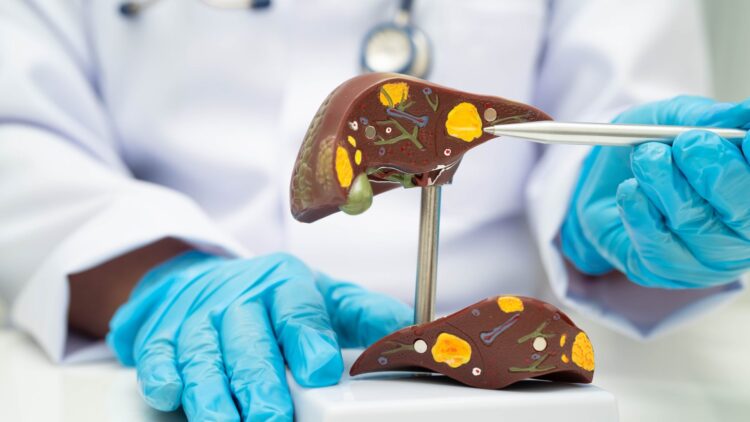 Fatty Liver Now Affects 1 in 3 Adults Without Warning Signs